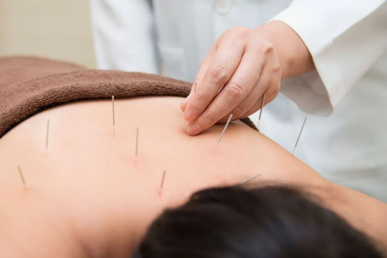 Discovering the Best TCM Acupuncture in Singapore: A Comprehensive Guide